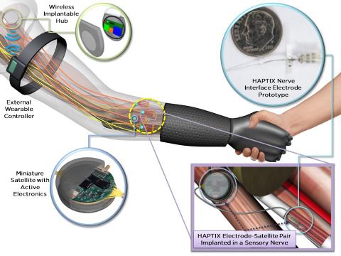 HAPTIX Electrode-Satellite Pair implanted in a Sensory Nerve
